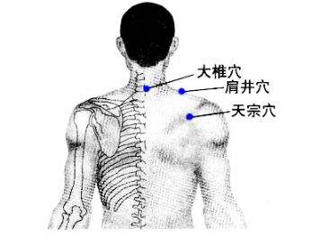 神经根型颈椎病的按摩