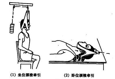 颈椎牵引治疗
