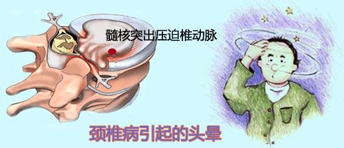 头晕也有可能是颈椎病引起的，你知道吗？
