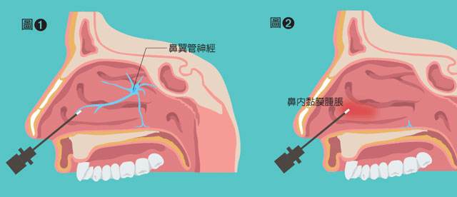 鼻炎该怎么治疗，使用颈椎治疗仪可以吗