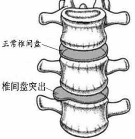 颈腰椎综合治疗仪作用原理_颈腰椎综合治疗仪适用人群