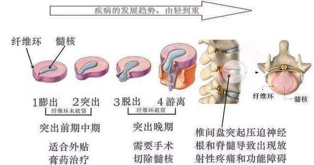 腰椎间盘突出症